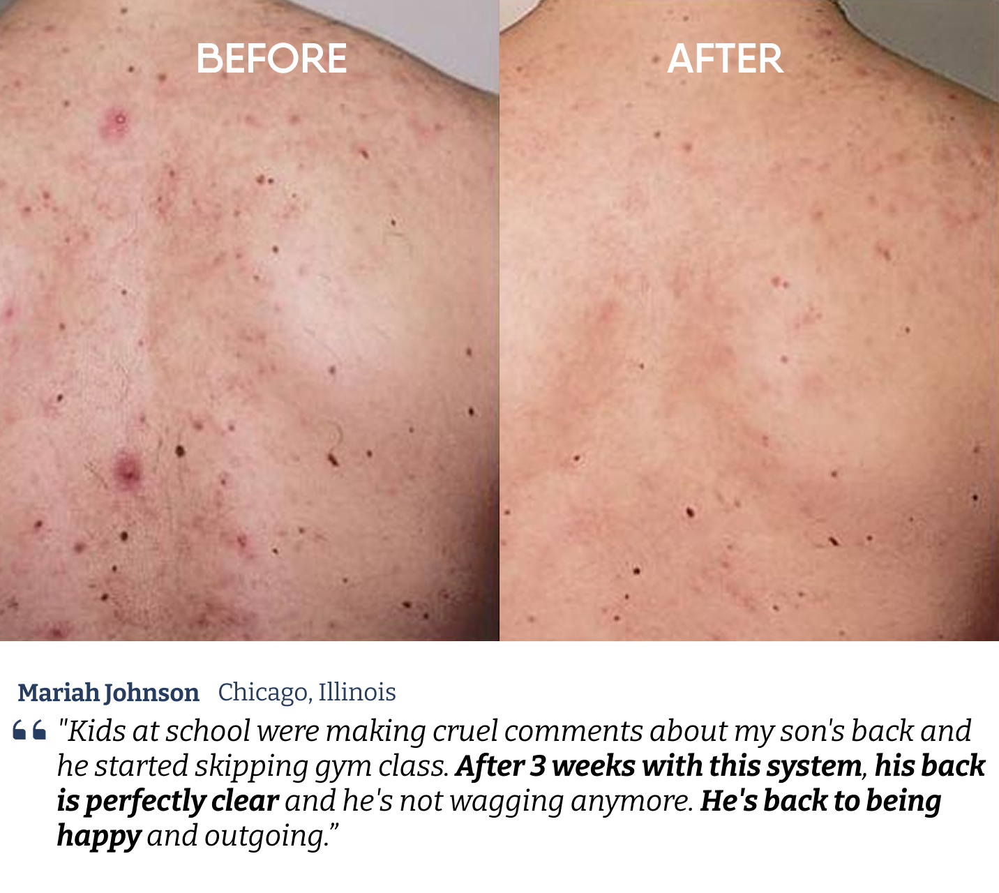 Manly Complete Acne Set